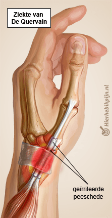 arm de quervain