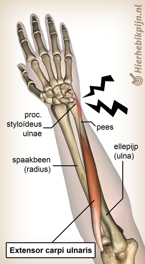 arm onderarm extensor carpi ulnaris tendinitis tendinopathie
