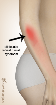 arm radiaal tunnel syndroom locatie