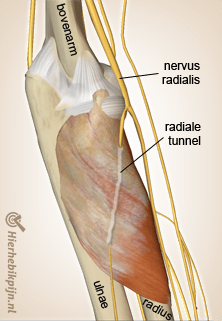 arm radiale tunnel nervus radialis