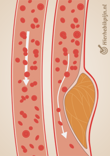 atheroslcerose slagader aderverkalking
