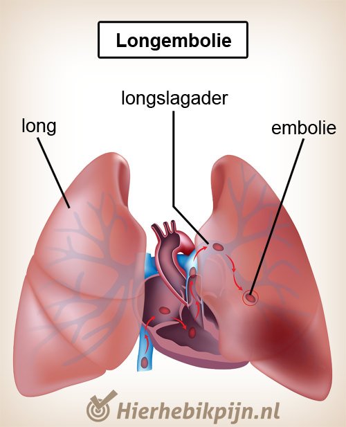 borst longen longembolie hart longslagader