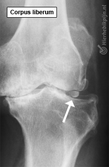 corpus liberum knie rontgen