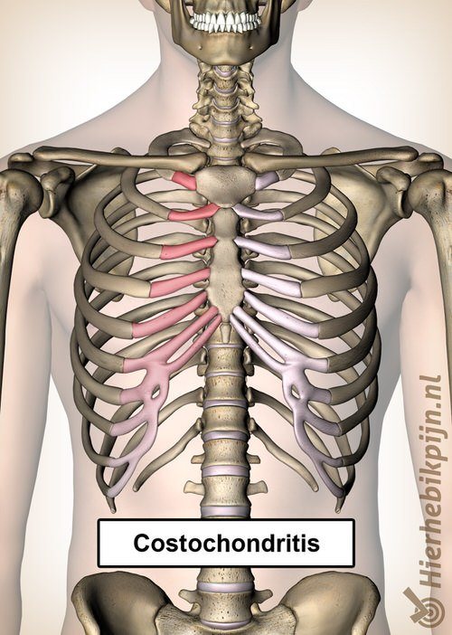 costochondritis ribben pijn borst borstbeen