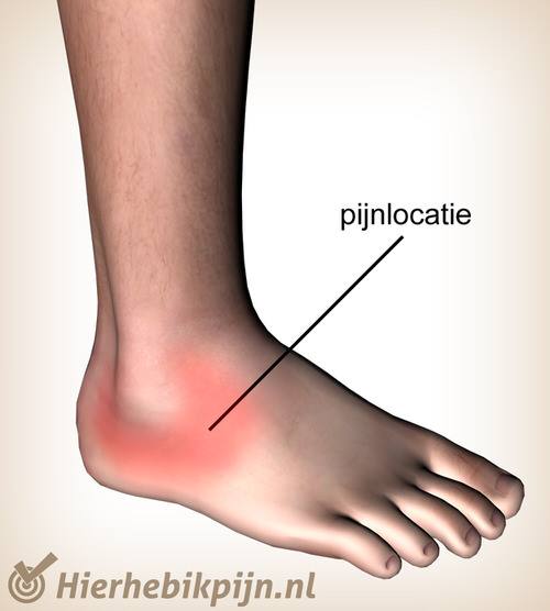 Salie klif verdrievoudigen Pijn aan de enkel | Blog | Hier Heb Ik Pijn