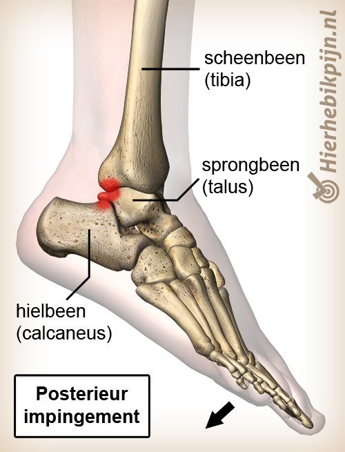 enkel posterior impingement plantair flexie