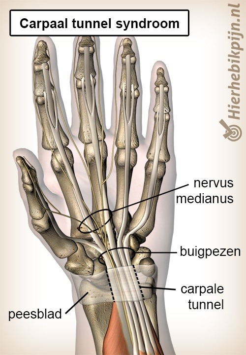 hand carpaal tunnel syndroom carpale inklemming