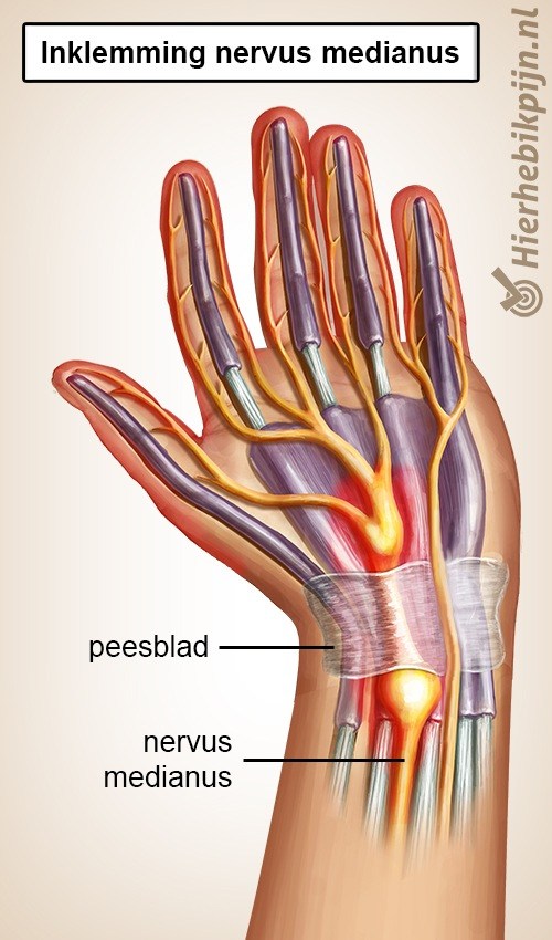 hand carpaal tunnel syndroom cts nervus medianus inklemming