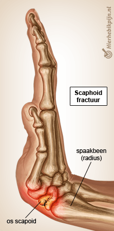 hand scaphoid fractuur