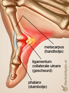 hand skiduim anatomie ligamentum collaterale ulnare