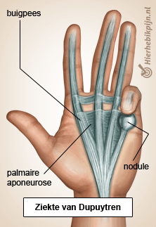 hand ziekte van dupuytren aponeurosis palmaris nodule