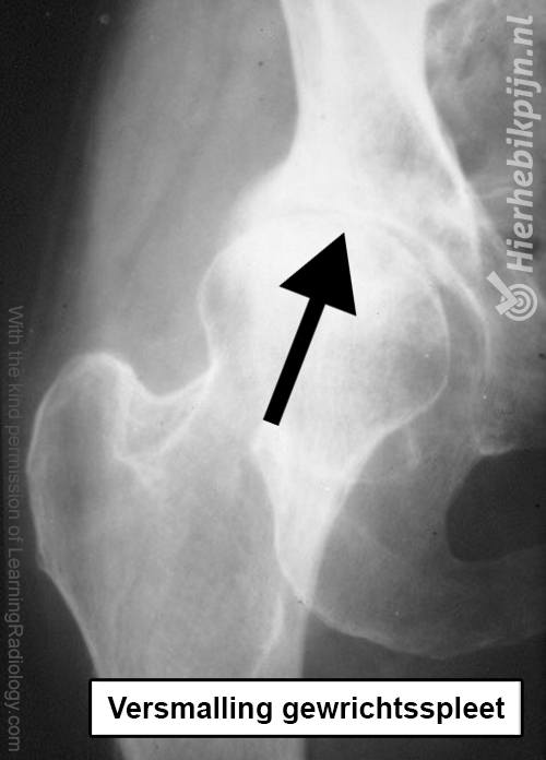 artrose | Oorzaak, & behandeling | Heb Ik Pijn