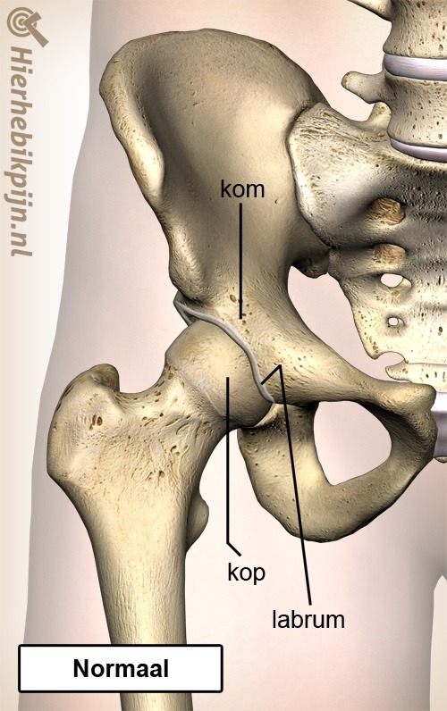 heup femoroacetabular impingement fai normaal