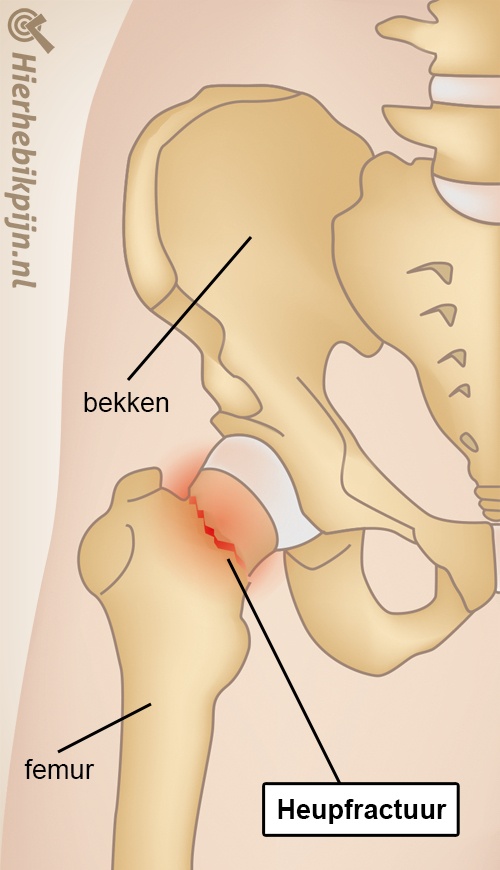 heup heupfractuur anatomie