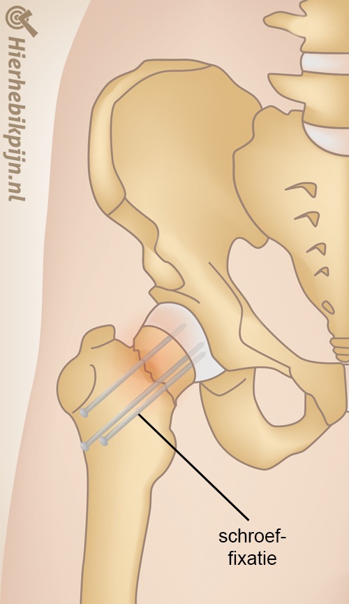 heup heupfractuur schroef fixatie