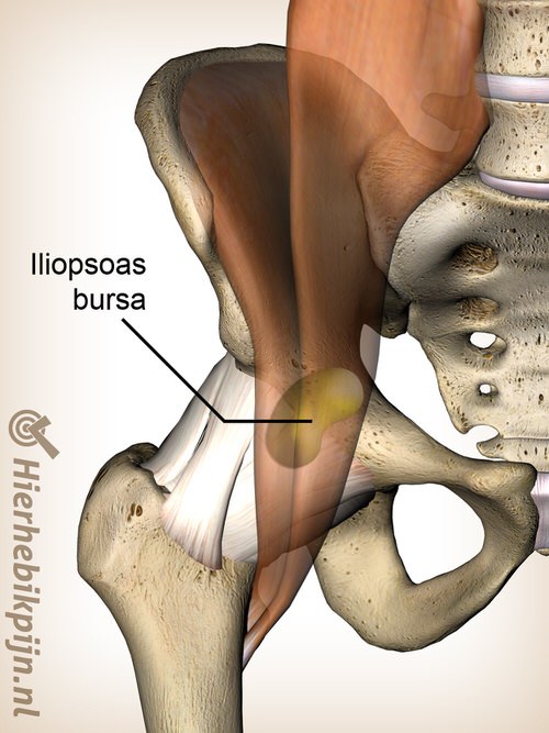 heup iliopsoas bursa bursitis