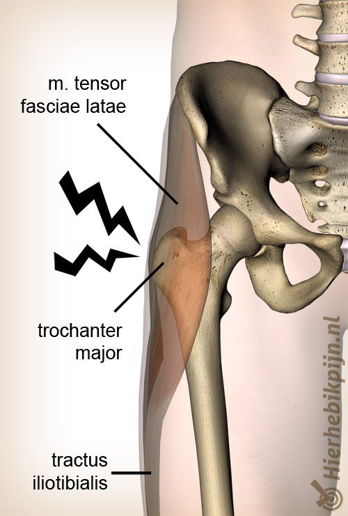 heup trochanter major pijnsyndroom anatomie tensor fasciae latae tractus iliotibialis