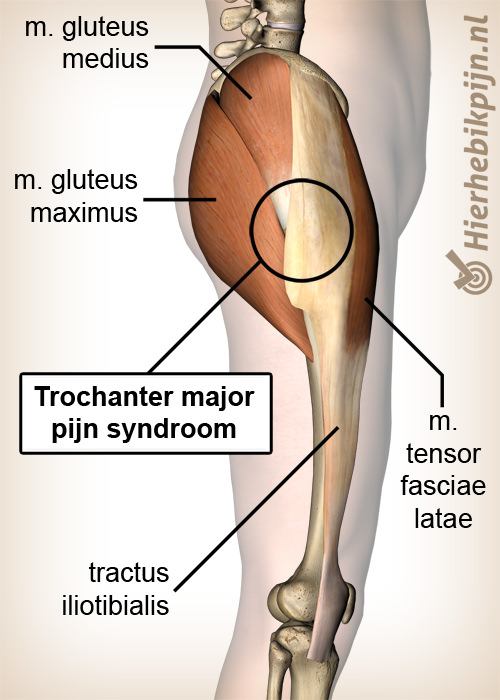 heup trochanter major pijnsyndroom anatomie