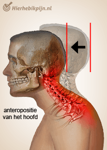 hoofd nek cervicaal houdingssyndroom anteropositie