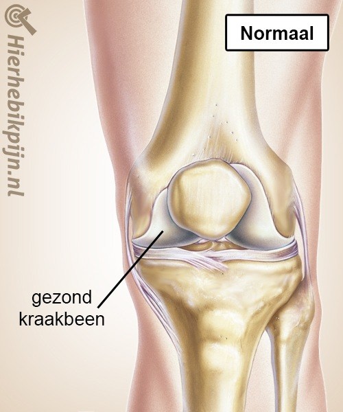 knie artrose gezond kraakbeen