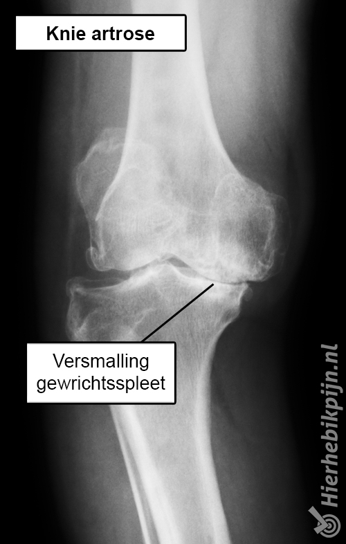 knie artrose rontgen