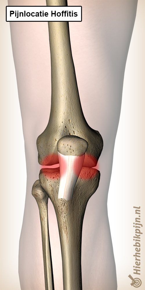 knie hoffitis pijnlocatie