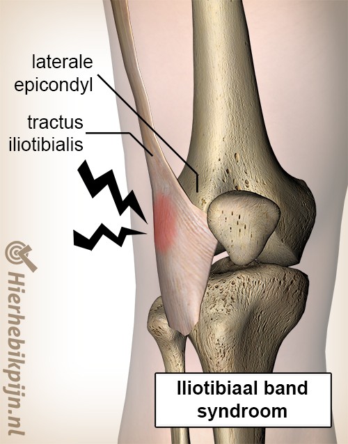 knie iliotibiaal band syndroom laterale epicondyl