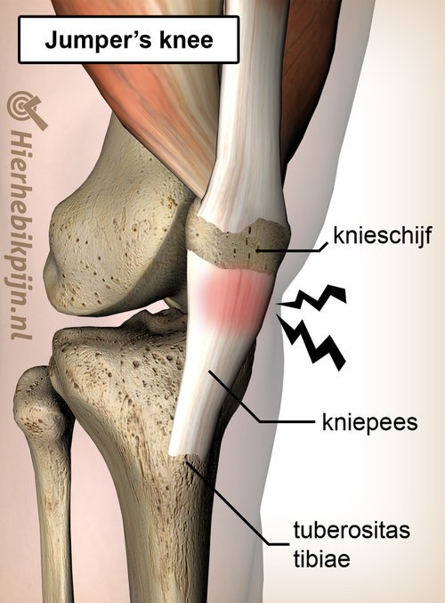 knie jumpers knee pijn patella pees tendinitis