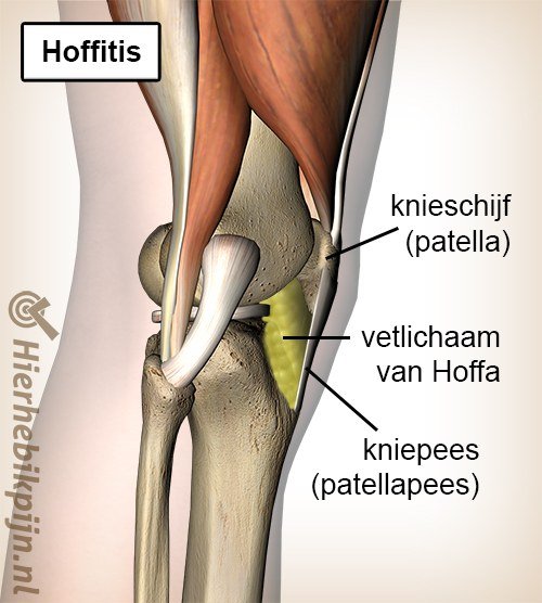 knie lichaam van hoffa hoffitis vetlichaam