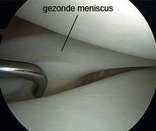 knie meniscus degeneratie gezond