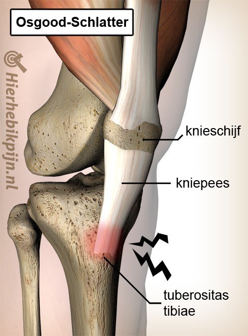 knie osgood schlatter pijn patella pees