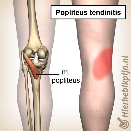 knie popliteus tendinitis