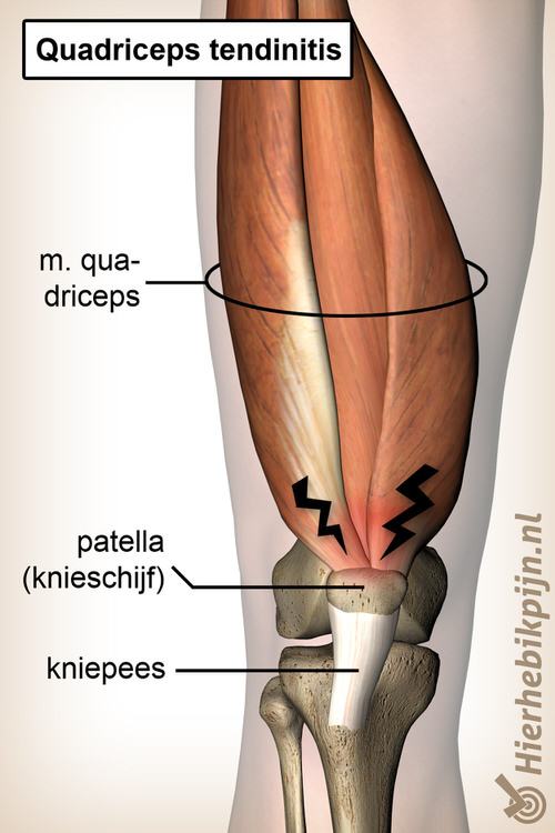 Hoofd Het eens zijn met Mondwater Quadriceps tendinitis | Oorzaak, symptomen & behandeling