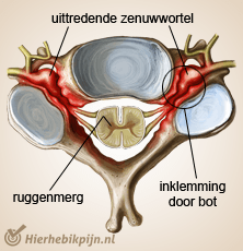 nek cervicale radiculopathie stenose harde nekhernia