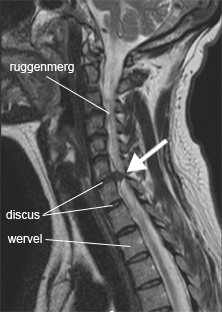 nek cervicale radiculopathie zachte nekhernia