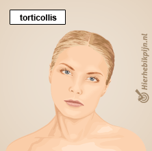 nek torticollis afwijking houding