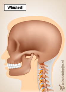 nek whiplash pijn