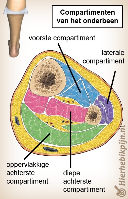 onderbeen compartimentsyndroom doorsnede compartimenten spieren