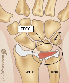 pols tfcc