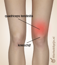 quadriceps tendinitis