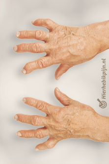 reumatoide artritis vingers