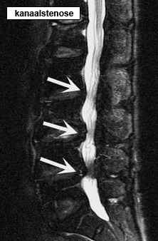 rug lumbale wervelkolom rontgen kanaalstenose vernauwing
