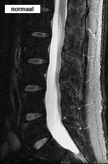 rug lumbale wervelkolom rontgen normaal