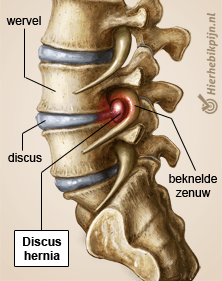 rug specifieke lage rugpijn discus hernia