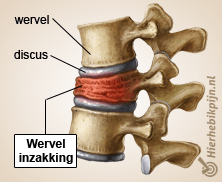 rug specifieke lage rugpijn ingezakte wervel