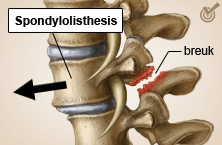 rug specifieke lage rugpijn spondylolisthesis verschoven wervel