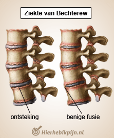 rug specifieke lage rugpijn ziekte van bechterew spondylitis ankylopoetica