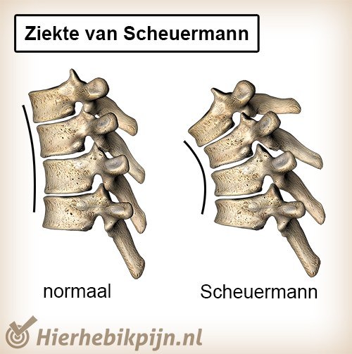 rug ziekte van scheuermann wervelkolom normaal bolling kyfose anatomie wigvormig