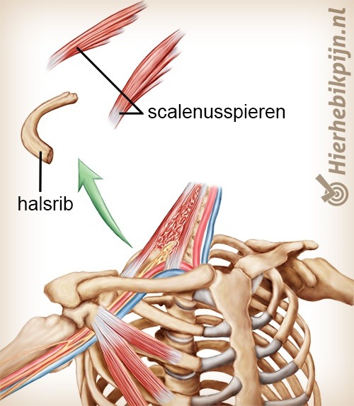 schouder arm hand tos thoracic outlet syndroom halsrib