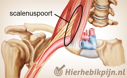 schouder arm hand tos thoracic outlet syndroom scalenuspoort